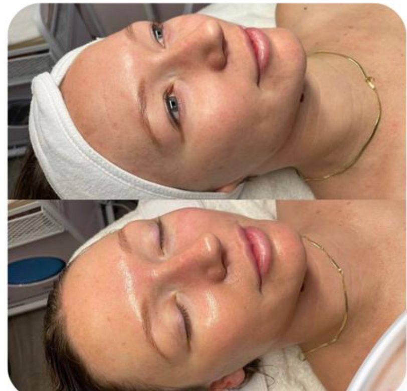 Essential Glow Facial results