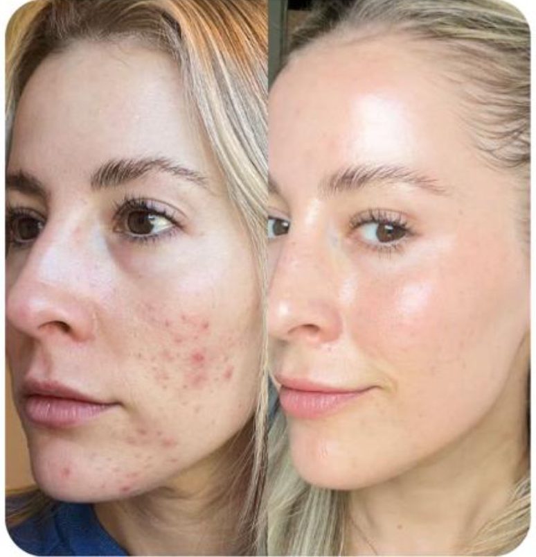 PowerClear Peel before and after
