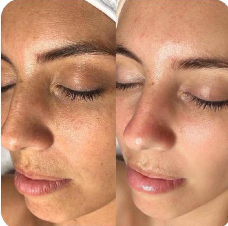 Advanced Renewal Peel before and after