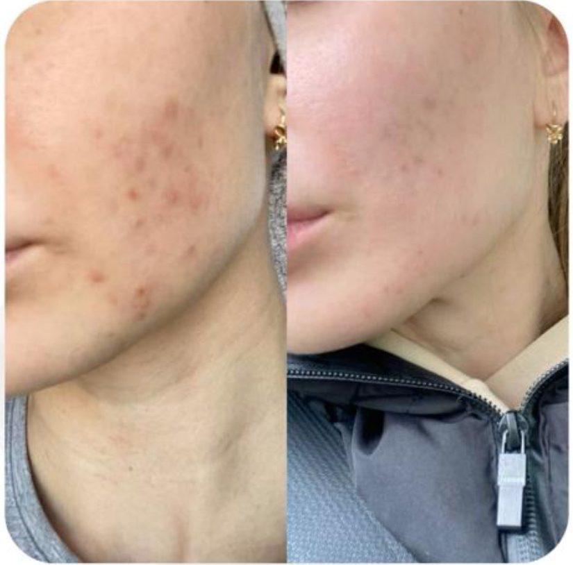 UltraBright Peel before and after one session